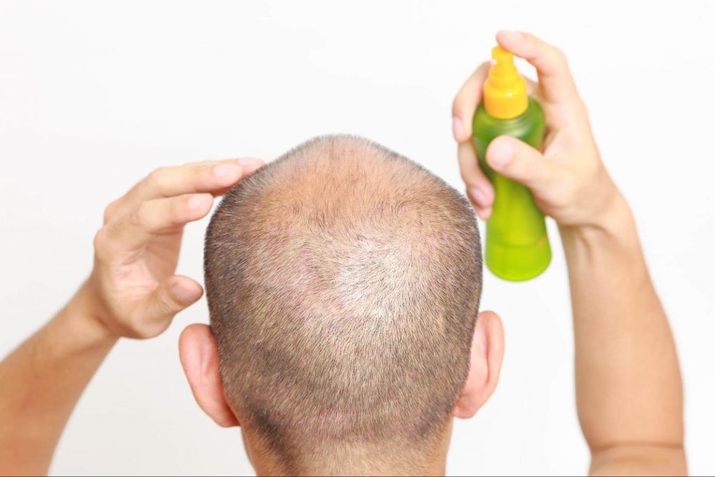 育毛剤を使う
