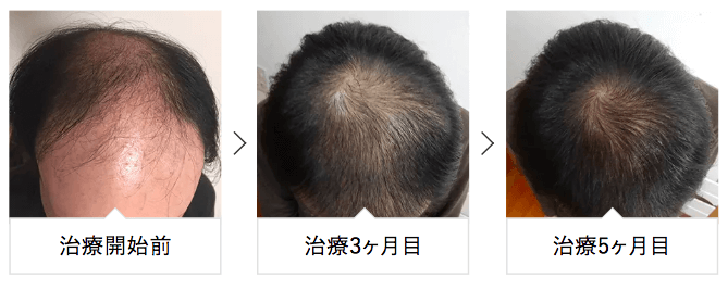 AGA治療を受けた男性の頭頂部｜治療前から3ヶ月、5ヶ月後のビフォーアフター
