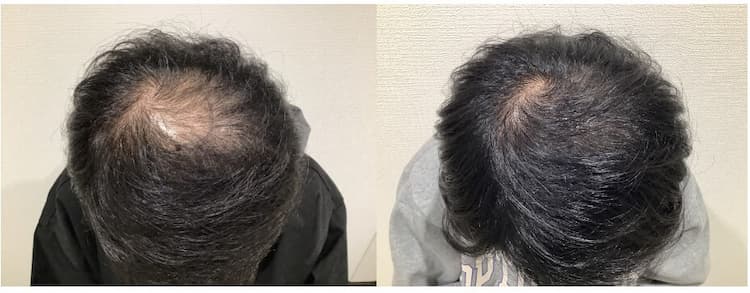 AGA治療を受けた男性の頭頂部｜5ヶ月後のビフォーアフター