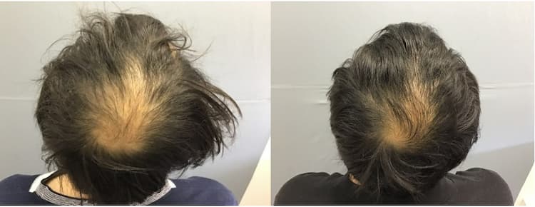 AGA治療を受けた男性の頭頂部｜5ヶ月後のビフォーアフター