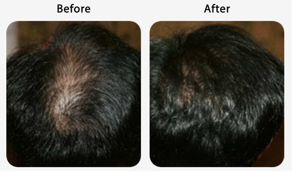 AGA治療を受けた男性の頭頂部｜4ヶ月後のビフォーアフター