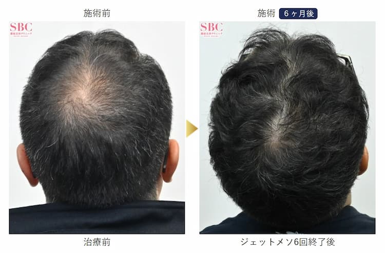 AGA治療を受けた男性の頭頂部|6ヶ月後のビフォーアフター