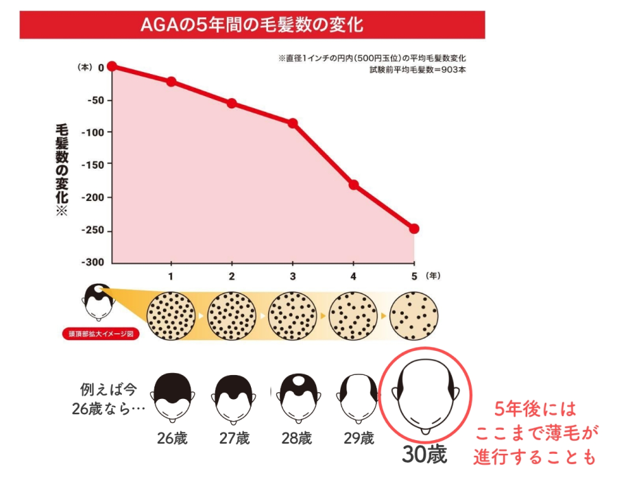 AGAの5年間の毛髪数の変化