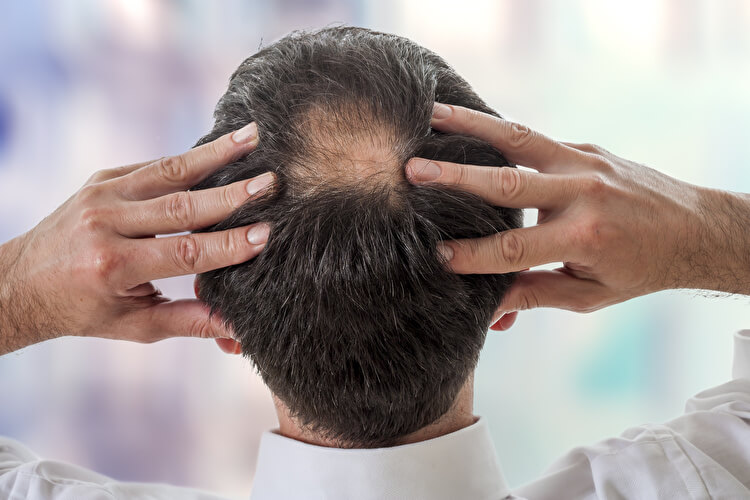 脱毛症の主な種類と原因｜男女で違う？症状ごとの有効な治療法