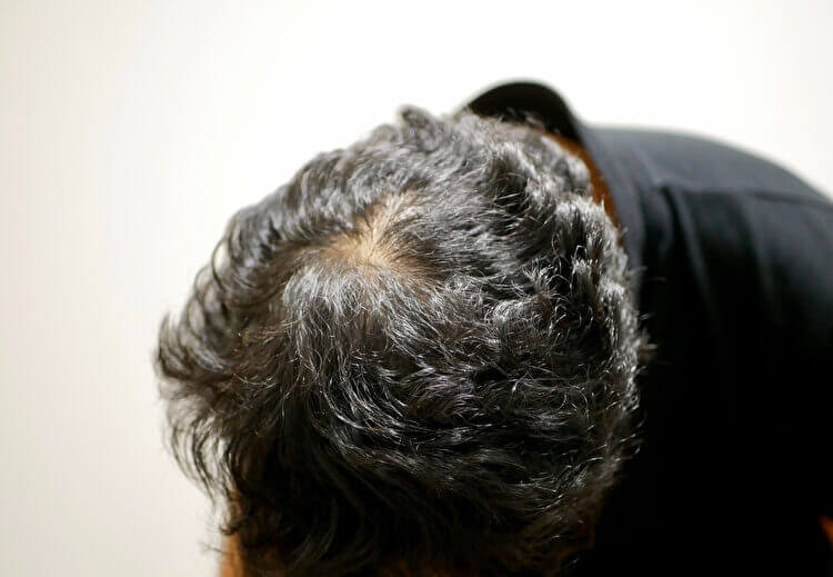 トリコチロマニア（抜毛癖）｜無意識のうちに髪の毛を抜いてしまう症状