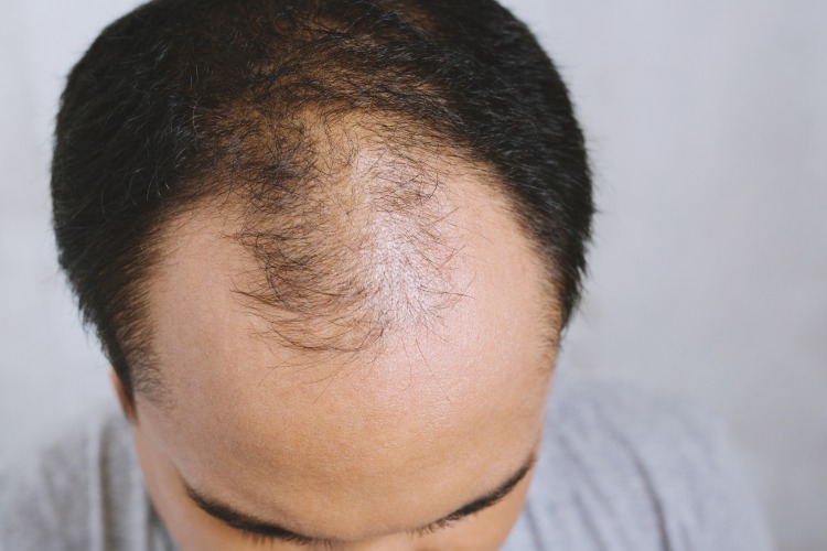 M字型の薄毛の原因となる2つの脱毛症状
