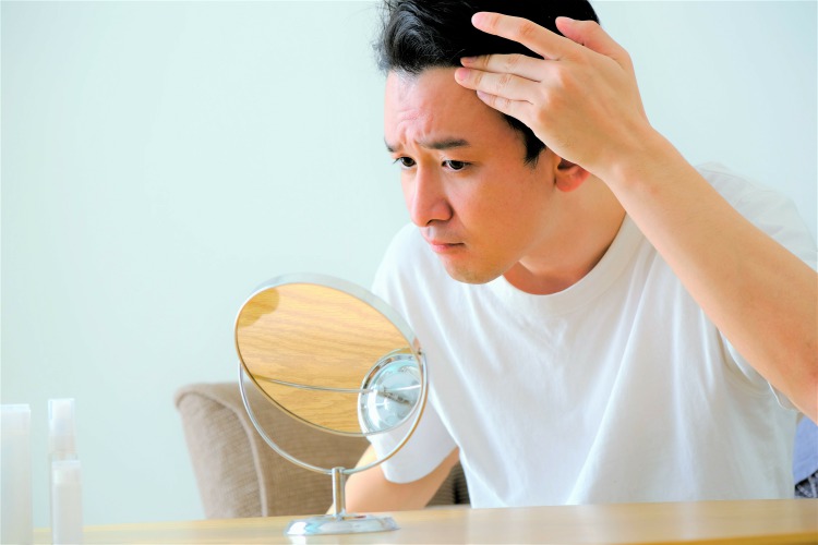 5αリダクターゼの活性度