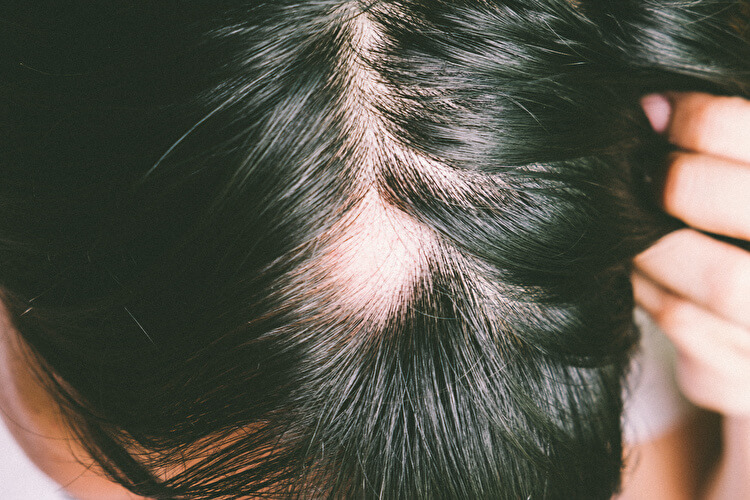 円形脱毛症の原因