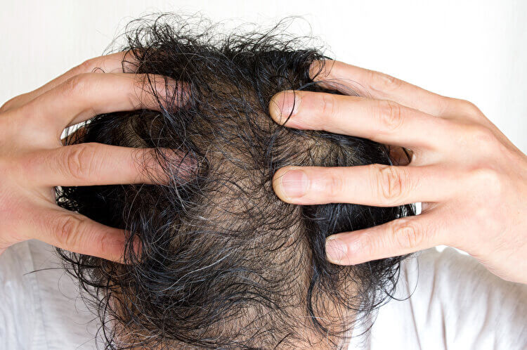 男性型脱毛症（AGA）の原因