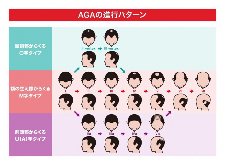 AGAの9つの進行パターン