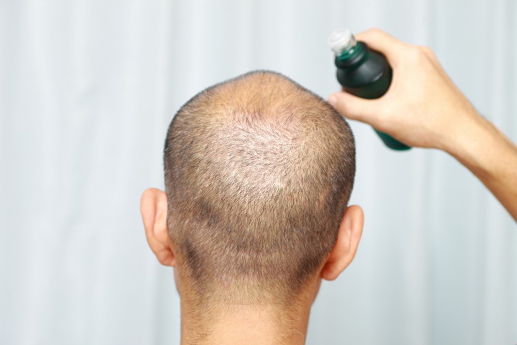 育毛剤を頭皮に塗布する男性の画像