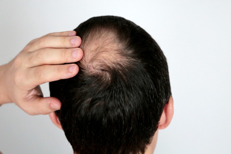 AGAとは？前頭部や頭頂部の薄毛が進行する男性型脱毛症