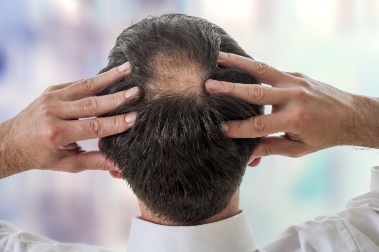 壮年性脱毛症とは？30〜50代で発症する進行型の脱毛症